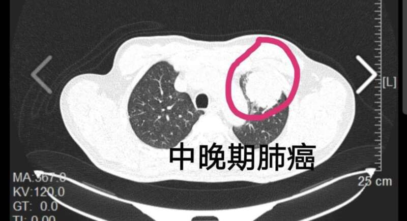 中晚期肺癌